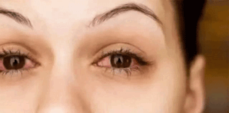 Eye Care: If you also see any auspicious sign of eye twitching then be careful.