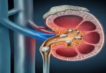 गलती से भी न खाएं ये चीजें, पथरी का दर्द कर देगा बेहाल