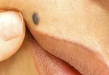 सिर्फ निशान नहीं है तिल, ऊपरी होंठ पर तिल बदल सकता है आपकी किस्मत!