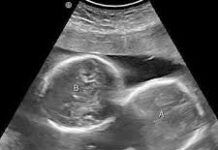 अल्ट्रासाउंड जांच में महिला के गर्भ में दो बच्चों की पुष्टि हुई थी