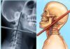 गले के आर-पार घुसा 12 मिमी सरिया, 3 घंटे सर्जरी से बची जान