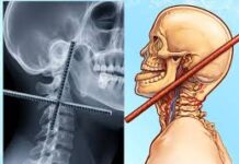 गले के आर-पार घुसा 12 मिमी सरिया, 3 घंटे सर्जरी से बची जान