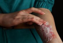 जलने पर कर सकते हैं ये घरेलू उपाय