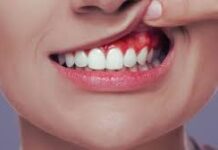 मसूड़ों की बीमारी पेरियोडोंटाइटिस हो सकती है गंभीर
