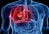 फेफड़ों की गंभीर बीमारी COPD के लिए नई उम्मीद, गेमचेंजर इंजेक्शन से इलाज होगा आसान
