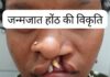 सफल सर्जरी से भीमे हेमला के चेहरे पर लौटी मुस्कान