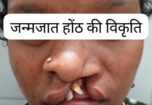 सफल सर्जरी से भीमे हेमला के चेहरे पर लौटी मुस्कान